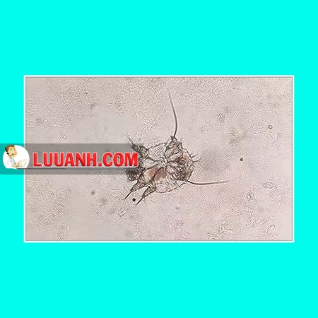 Trẻ quấy khóc kèm mụn sẩn toàn thân 5 ghẻ