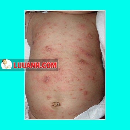 Trẻ quấy khóc kèm mụn sẩn toàn thân 4 trẻ