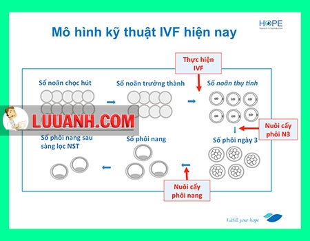 Đi làm IVF - chuyển phôi ngày 3 hay ngày 5 ? 5 ivf