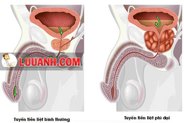 Tiền liệt tuyến của bệnh nhân bị u xơ