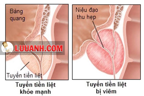 Tiền liệt tuyến bị viêm