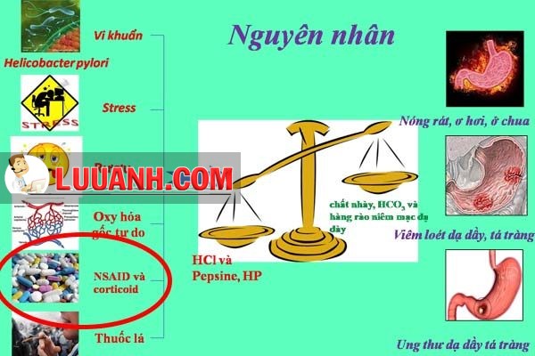 NSAID là một trong những nguyên nhân gây viêm loét dạ dày tá tràng