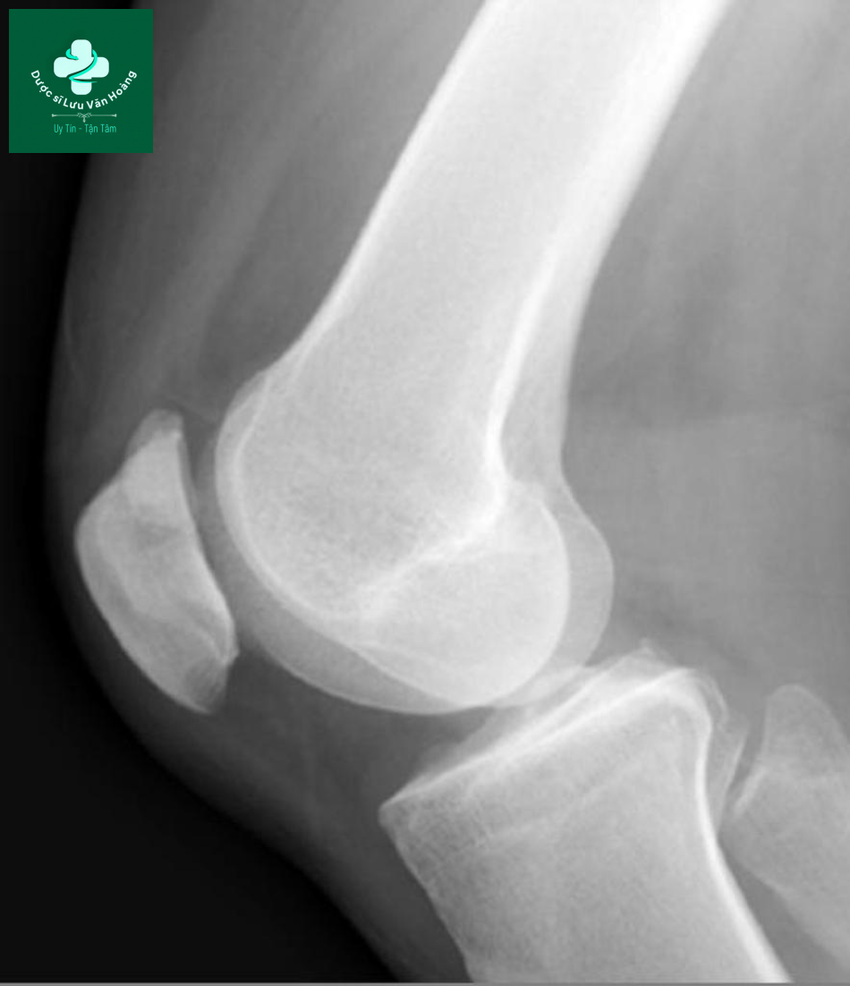 Bipartite patella 2