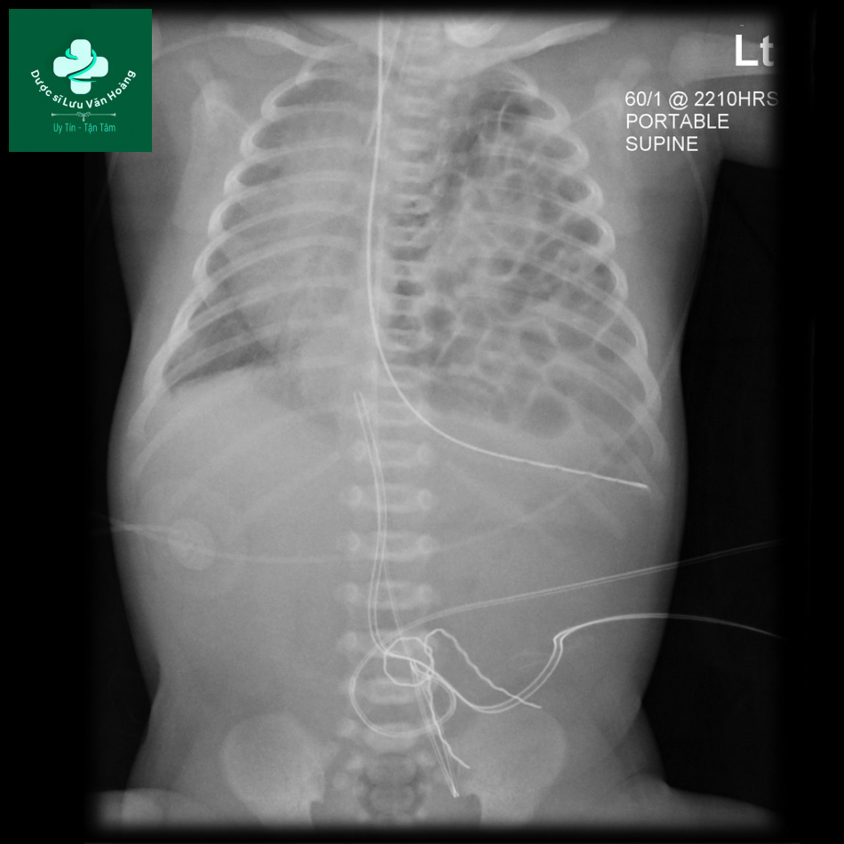 Dị dạng đường thở bẩm sinh - CPAM 28 CPAM 13