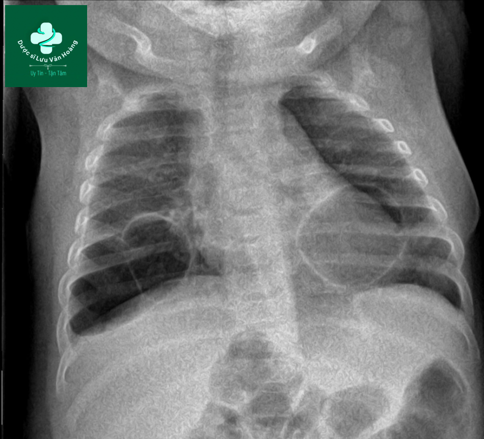 Dị dạng đường thở bẩm sinh - CPAM 29 CPAM 14