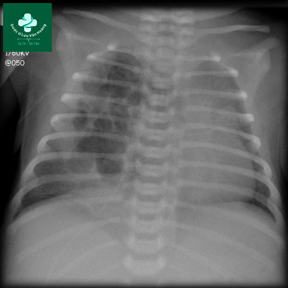 Dị dạng đường thở bẩm sinh - CPAM 20 CPAM 5