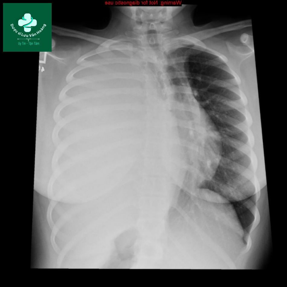 Sarcoma Ewing (thành ngực)- Ewing sarcoma (chest wall) 23 Screenshot 252