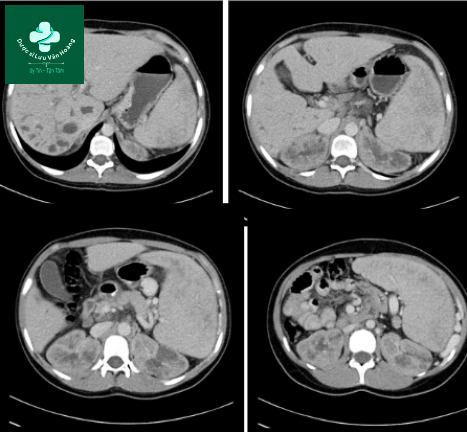 Bệnh Caroli - Caroli disease 11 Caroli 1
