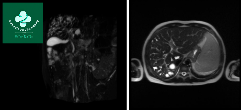 Bệnh Caroli - Caroli disease 12 Caroli 2