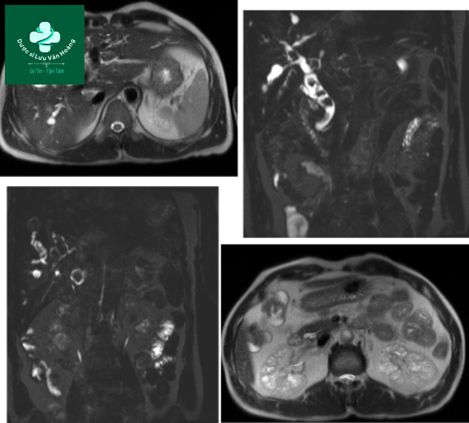 Bệnh Caroli - Caroli disease 13 Caroli 3