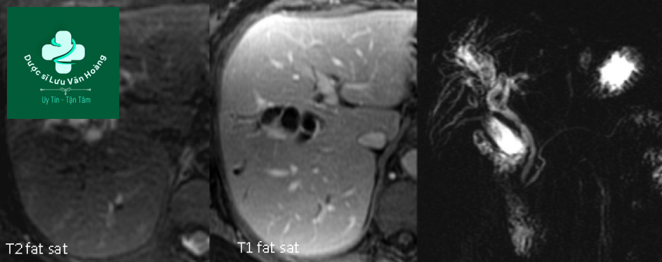 Bệnh Caroli - Caroli disease 14 Caroli 4