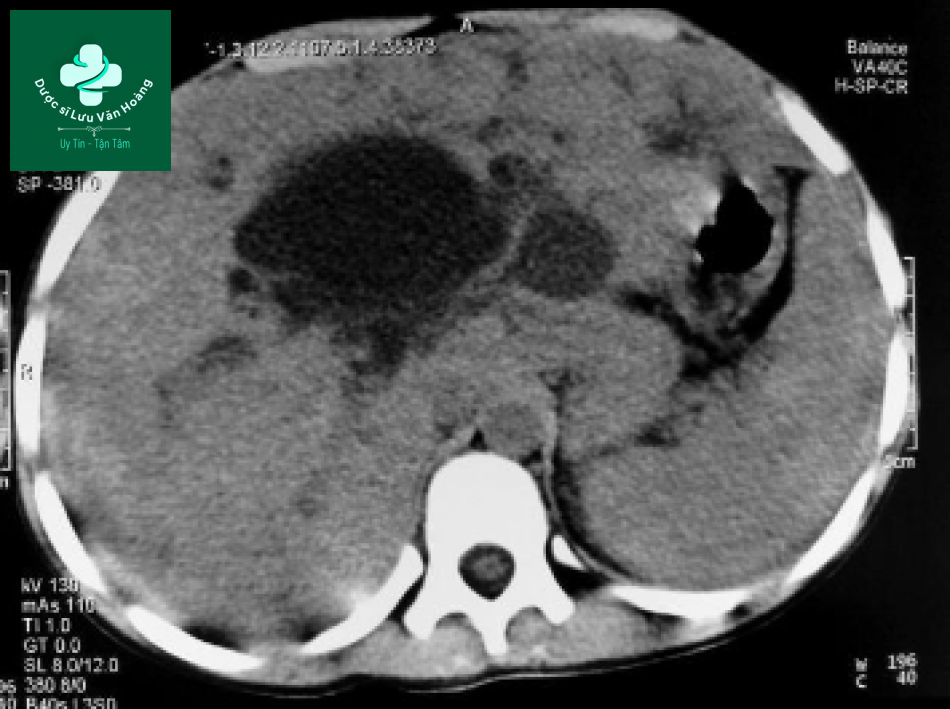 Bệnh Caroli - Caroli disease 16 Caroli 5