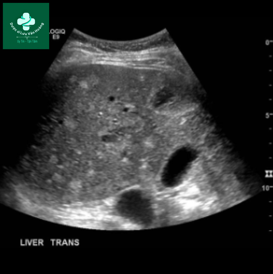 Bệnh Caroli - Caroli disease 17 Caroli 6