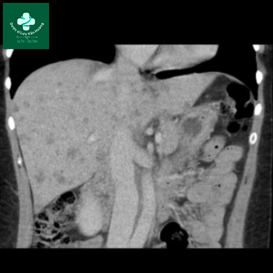 Bệnh Caroli - Caroli disease 18 Caroli 7