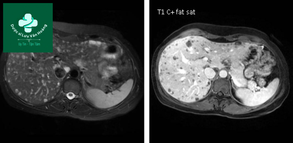 Bệnh Caroli - Caroli disease 19 Caroli 8