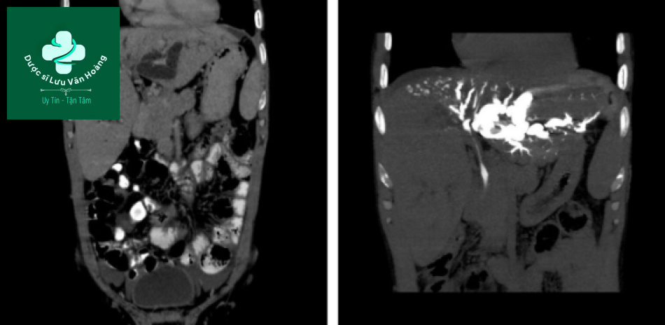 Bệnh Caroli - Caroli disease 15 Caroli 9