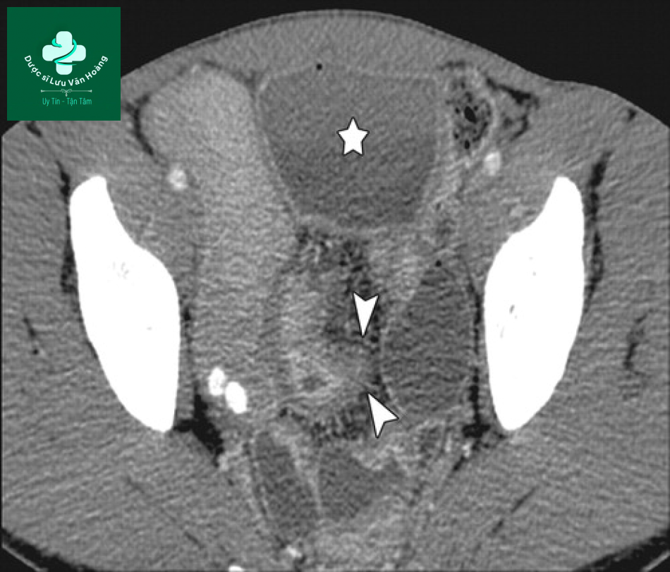 Tắc ruột non - Small Bowel Obstruction: What to Look For 43 Tac ruot non 10