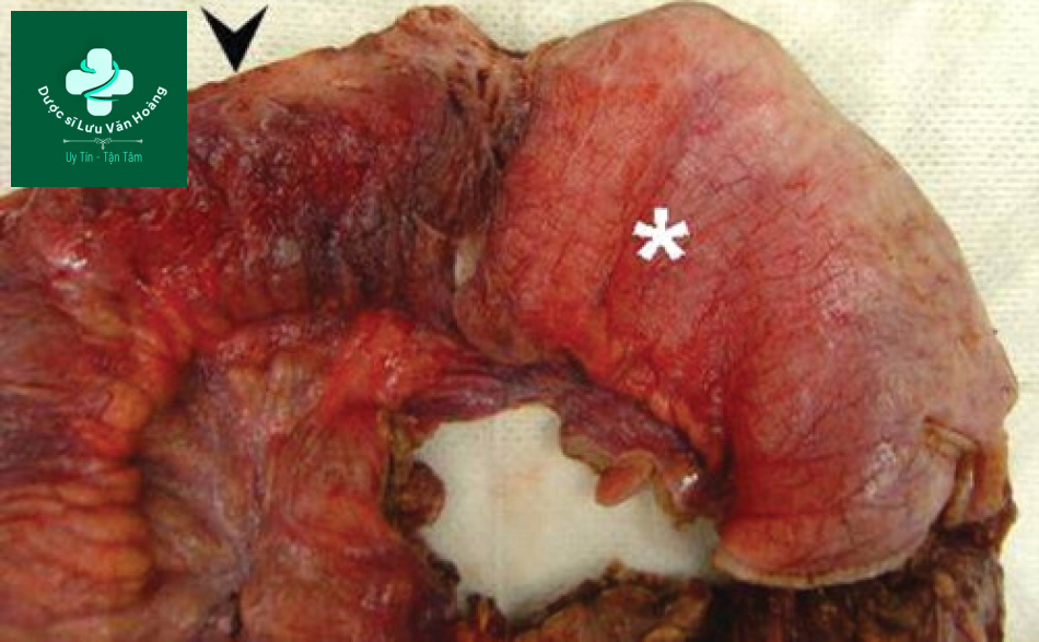 Tắc ruột non - Small Bowel Obstruction: What to Look For 44 Tac ruot non 11