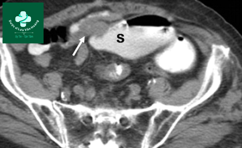 Tắc ruột non - Small Bowel Obstruction: What to Look For 45 Tac ruot non 12
