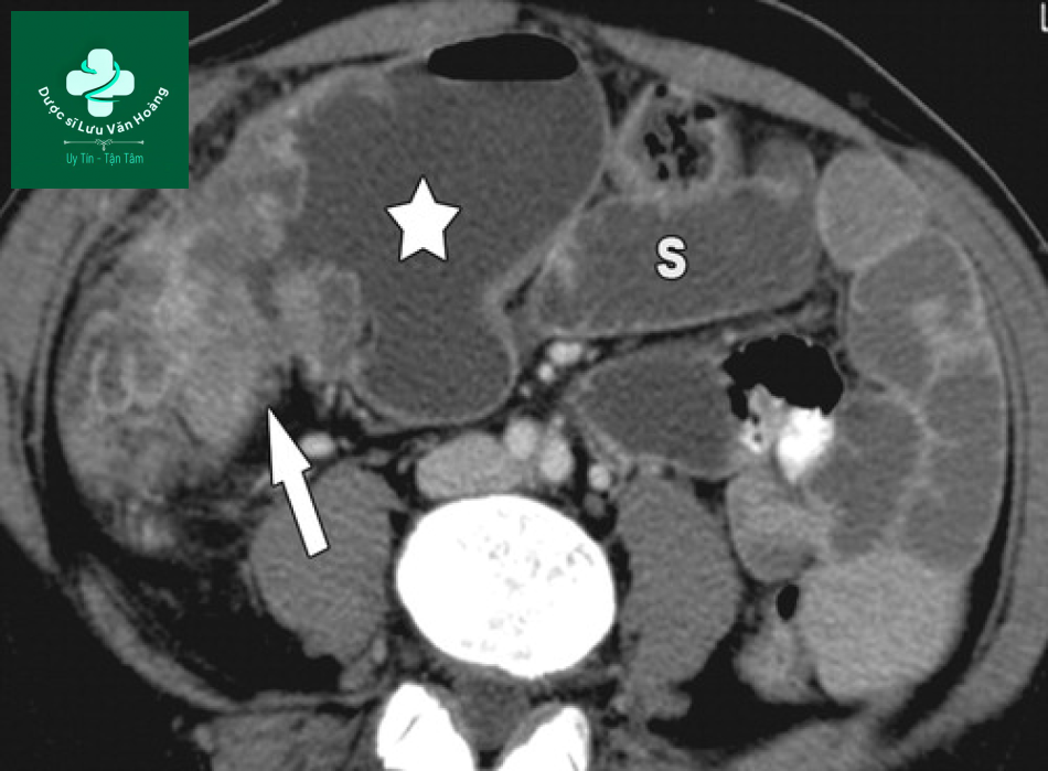 Tắc ruột non - Small Bowel Obstruction: What to Look For 46 Tac ruot non 13