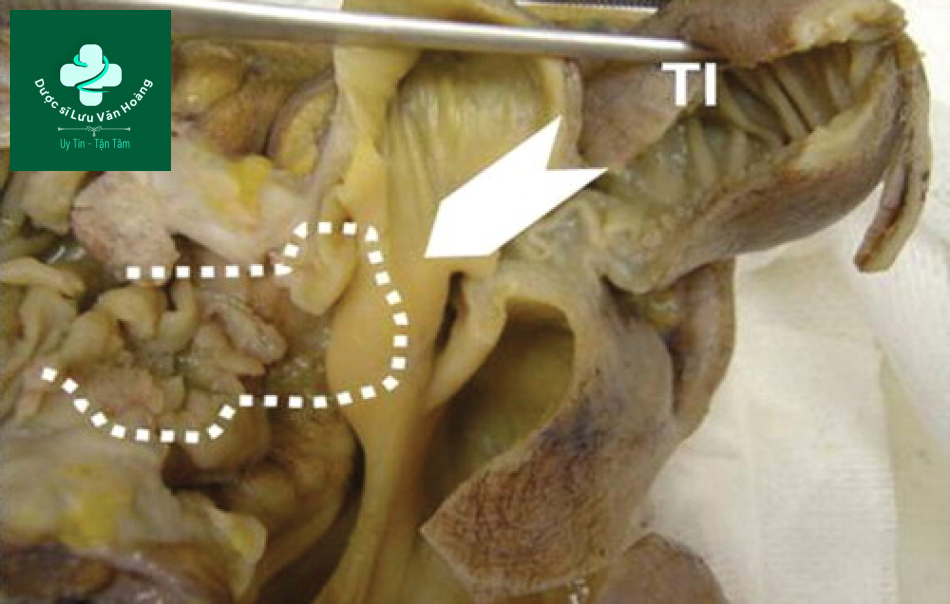 Tắc ruột non - Small Bowel Obstruction: What to Look For 47 Tac ruot non 14