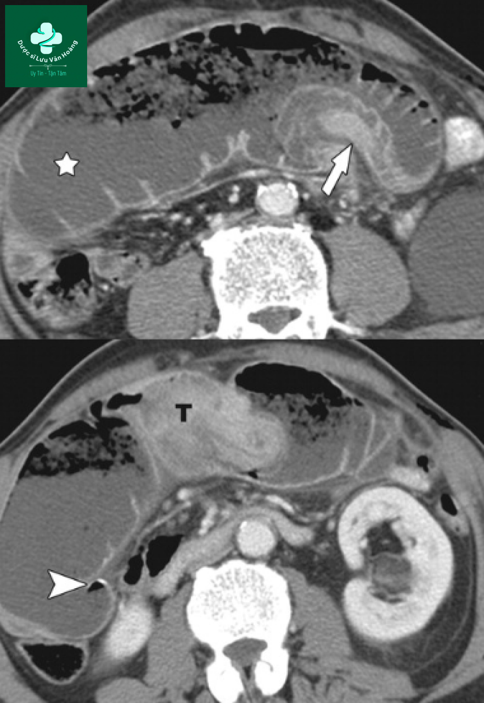 Tắc ruột non - Small Bowel Obstruction: What to Look For 48 Tac ruot non 15
