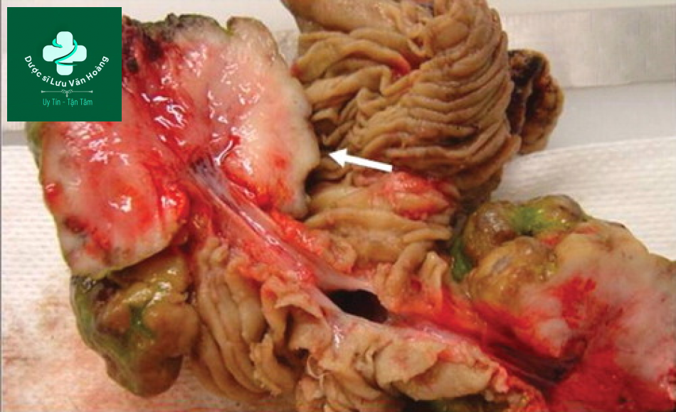 Tắc ruột non - Small Bowel Obstruction: What to Look For 49 Tac ruot non 16