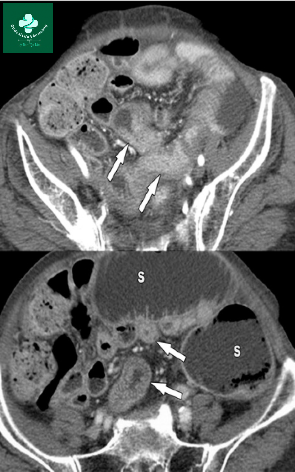 Tắc ruột non - Small Bowel Obstruction: What to Look For 50 Tac ruot non 17