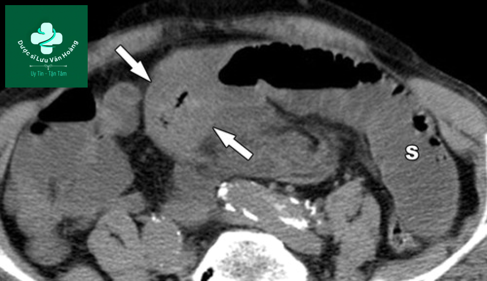 Tắc ruột non - Small Bowel Obstruction: What to Look For 51 Tac ruot non 18