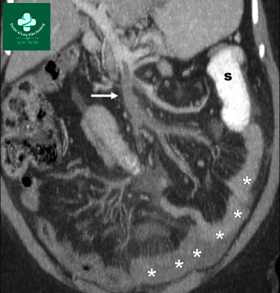 Tắc ruột non - Small Bowel Obstruction: What to Look For 52 Tac ruot non 19