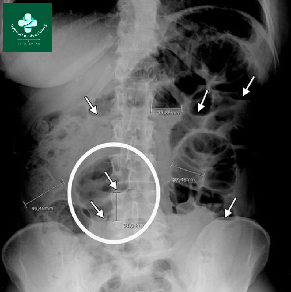Tắc ruột non - Small Bowel Obstruction: What to Look For 35 Tac ruot non 2