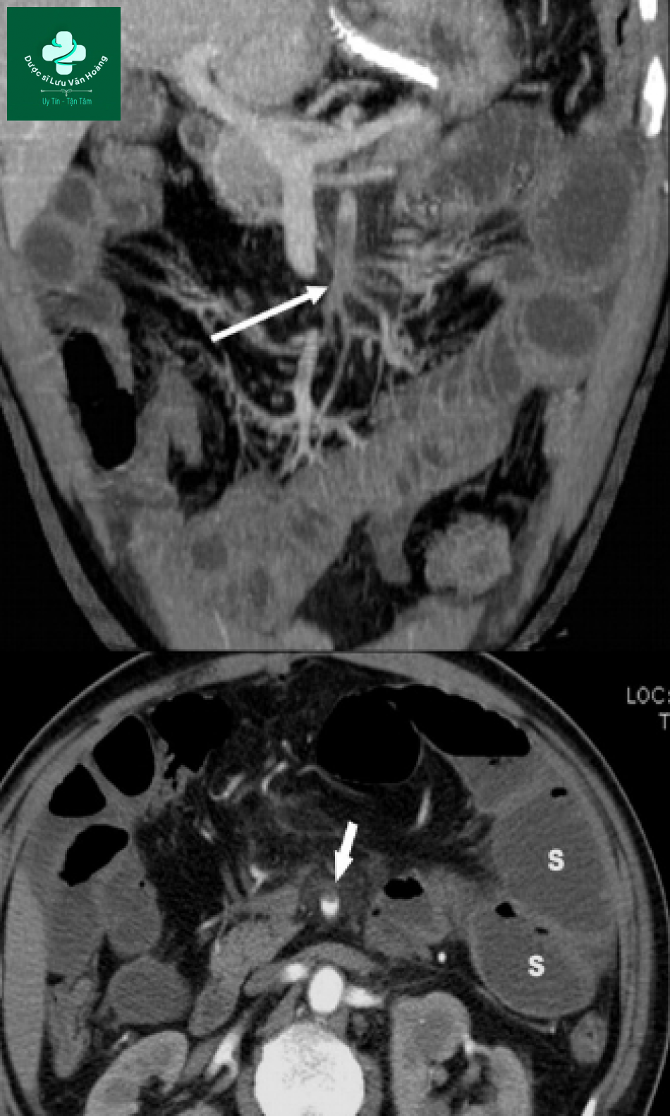 Tắc ruột non - Small Bowel Obstruction: What to Look For 54 Tac ruot non 21