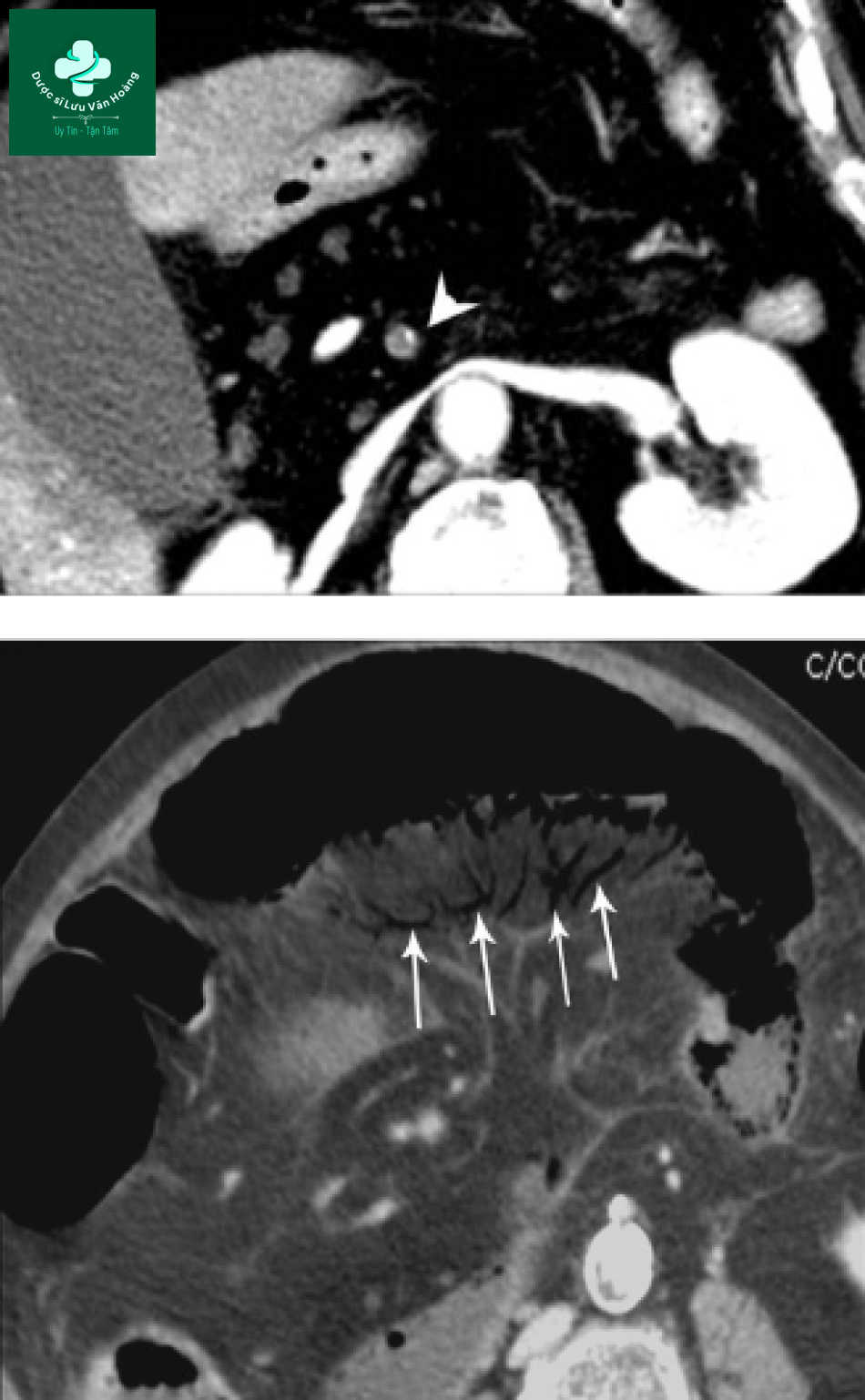 Tắc ruột non - Small Bowel Obstruction: What to Look For 55 Tac ruot non 22
