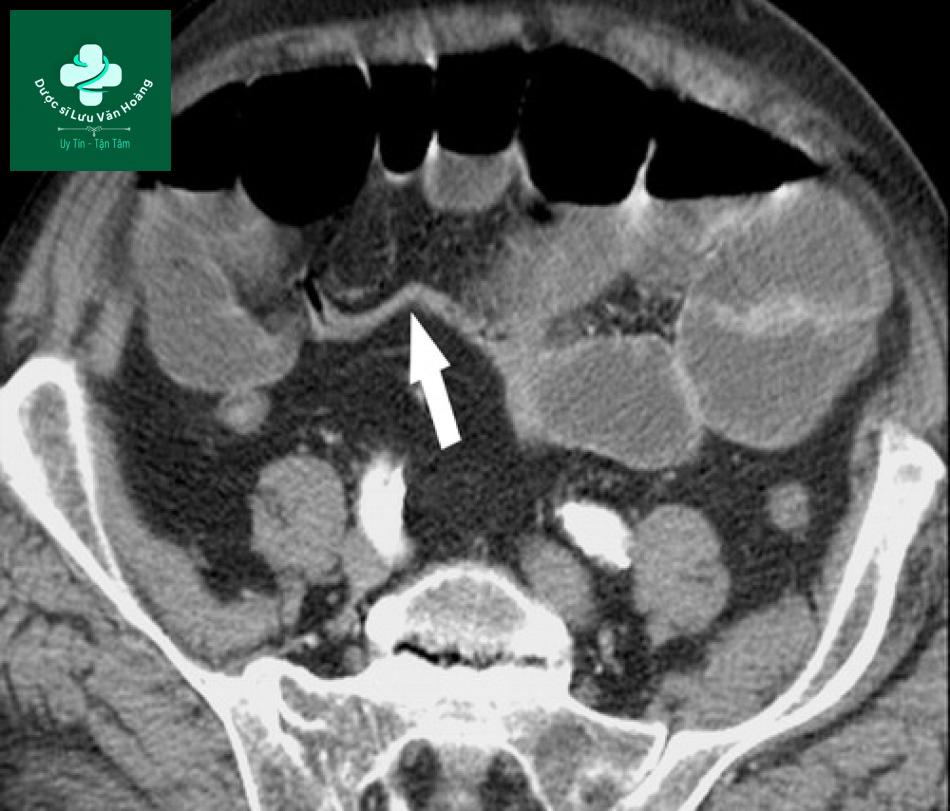 Tắc ruột non - Small Bowel Obstruction: What to Look For 56 Tac ruot non 23
