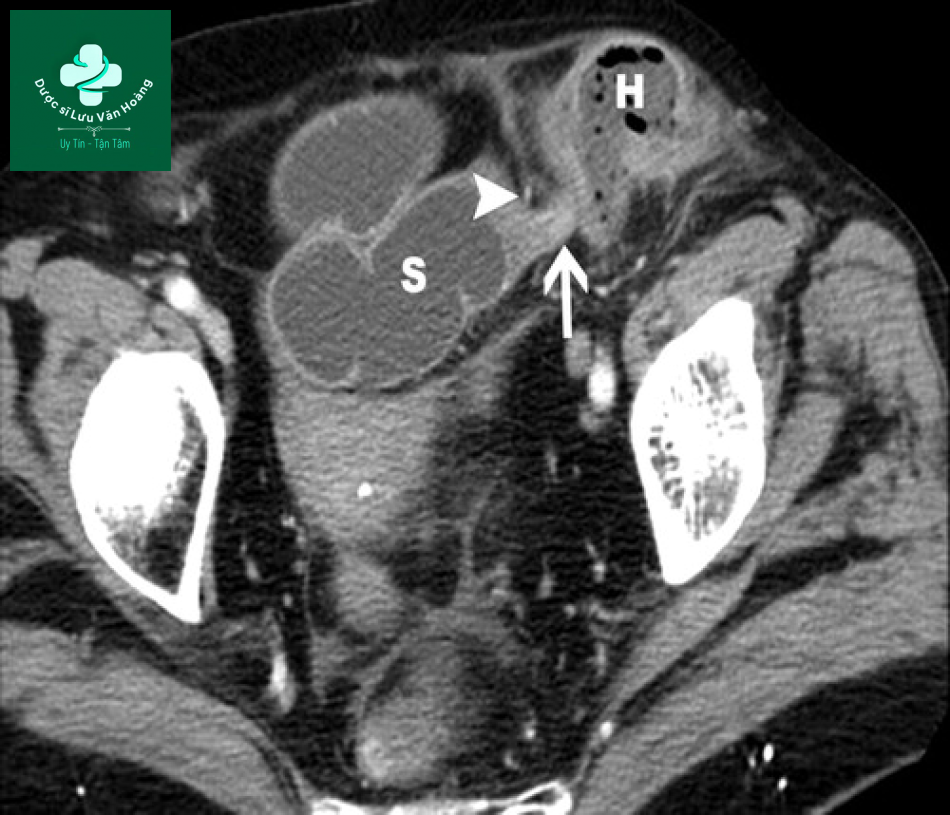 Tắc ruột non - Small Bowel Obstruction: What to Look For 57 Tac ruot non 24