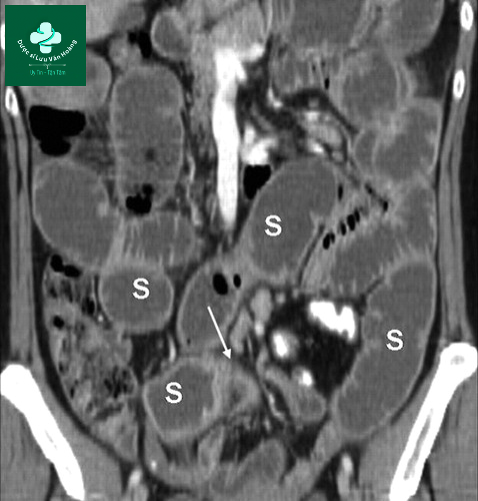 Tắc ruột non - Small Bowel Obstruction: What to Look For 58 Tac ruot non 25