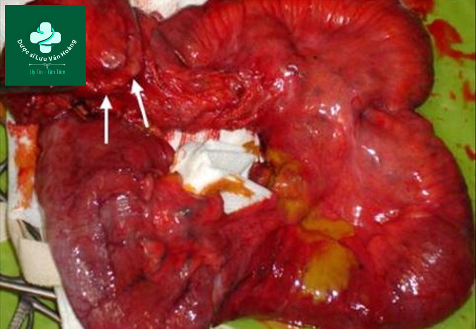 Tắc ruột non - Small Bowel Obstruction: What to Look For 59 Tac ruot non 26