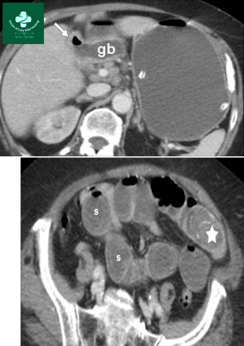 Tắc ruột non - Small Bowel Obstruction: What to Look For 60 Tac ruot non 27