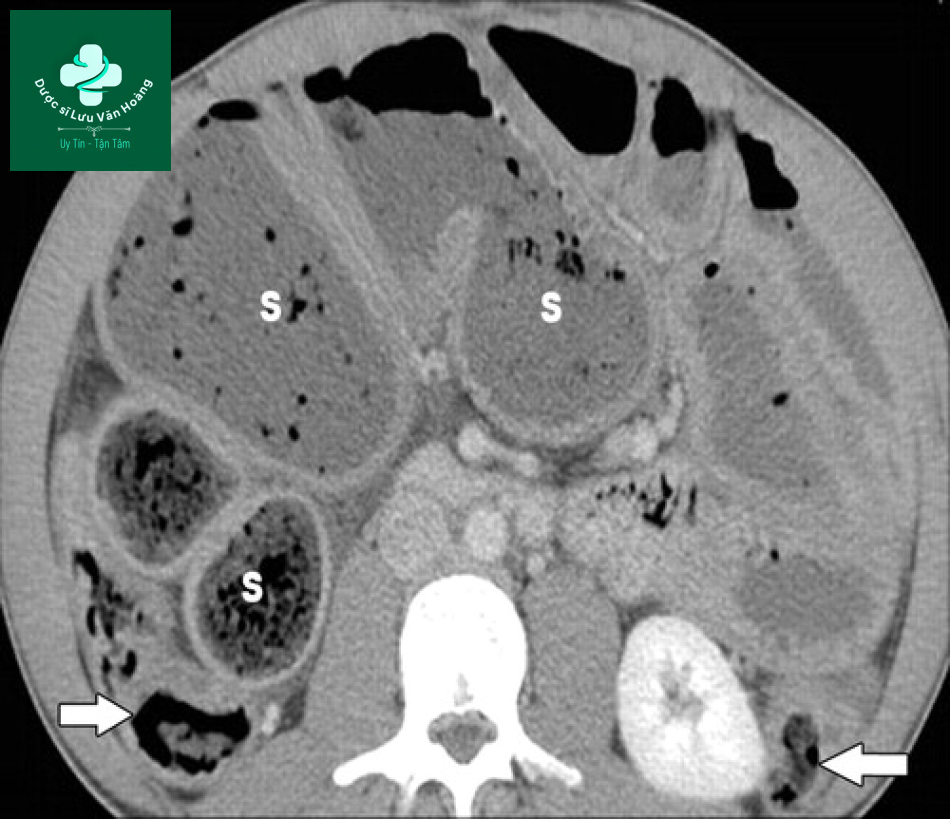 Tắc ruột non - Small Bowel Obstruction: What to Look For 61 Tac ruot non 28