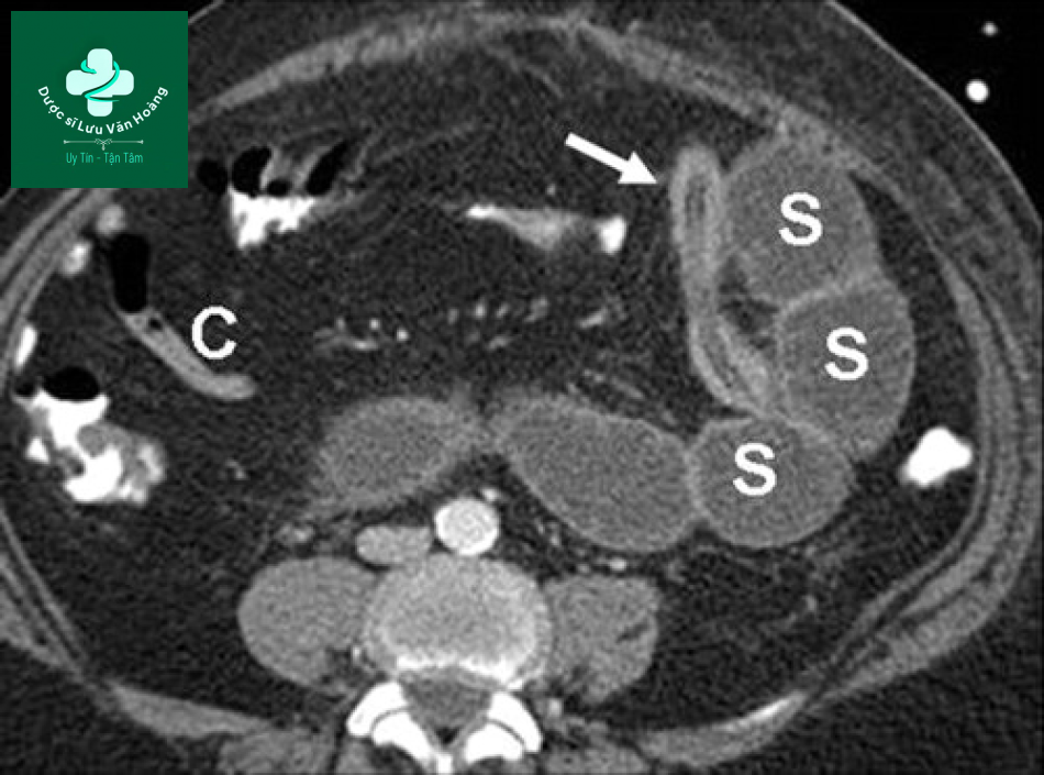 Tắc ruột non - Small Bowel Obstruction: What to Look For 62 Tac ruot non 29