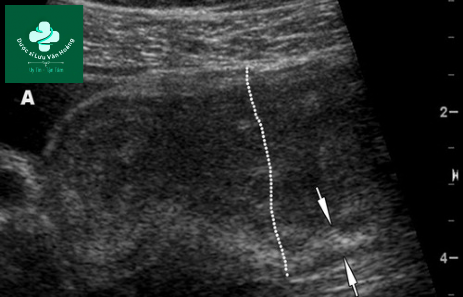 Tắc ruột non - Small Bowel Obstruction: What to Look For 36 Tac ruot non 3