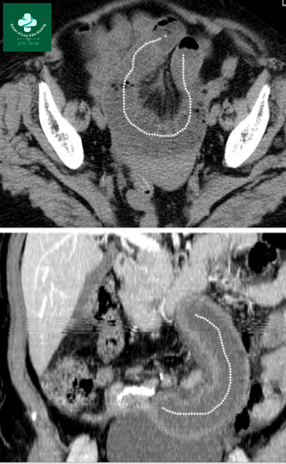 Tắc ruột non - Small Bowel Obstruction: What to Look For 63 Tac ruot non 30