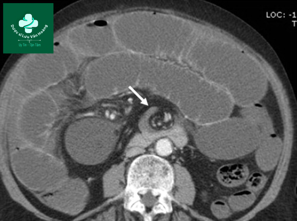 Tắc ruột non - Small Bowel Obstruction: What to Look For 64 Tac ruot non 31