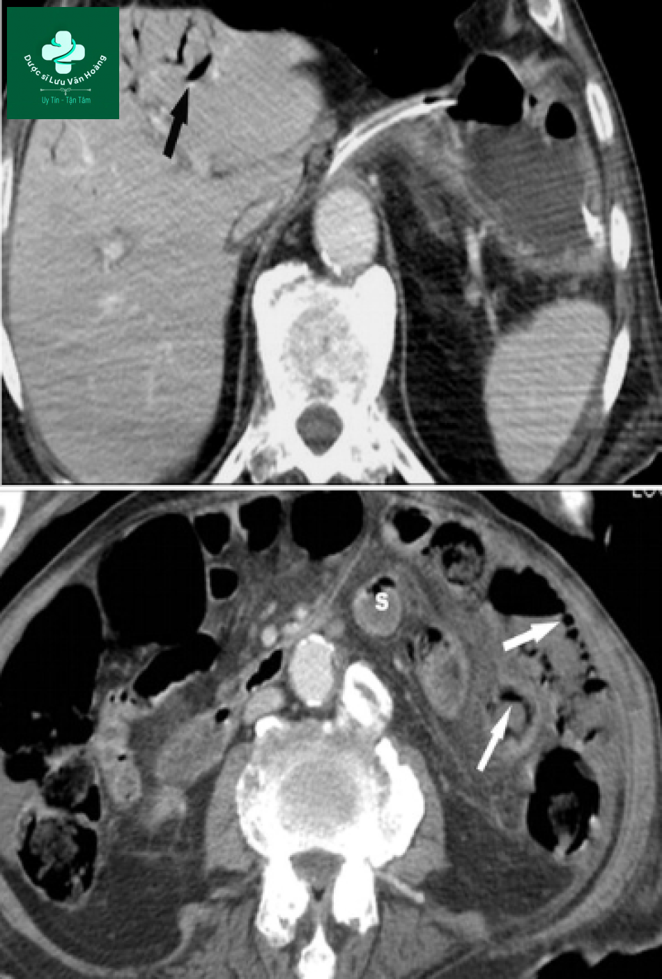 Tắc ruột non - Small Bowel Obstruction: What to Look For 65 Tac ruot non 32