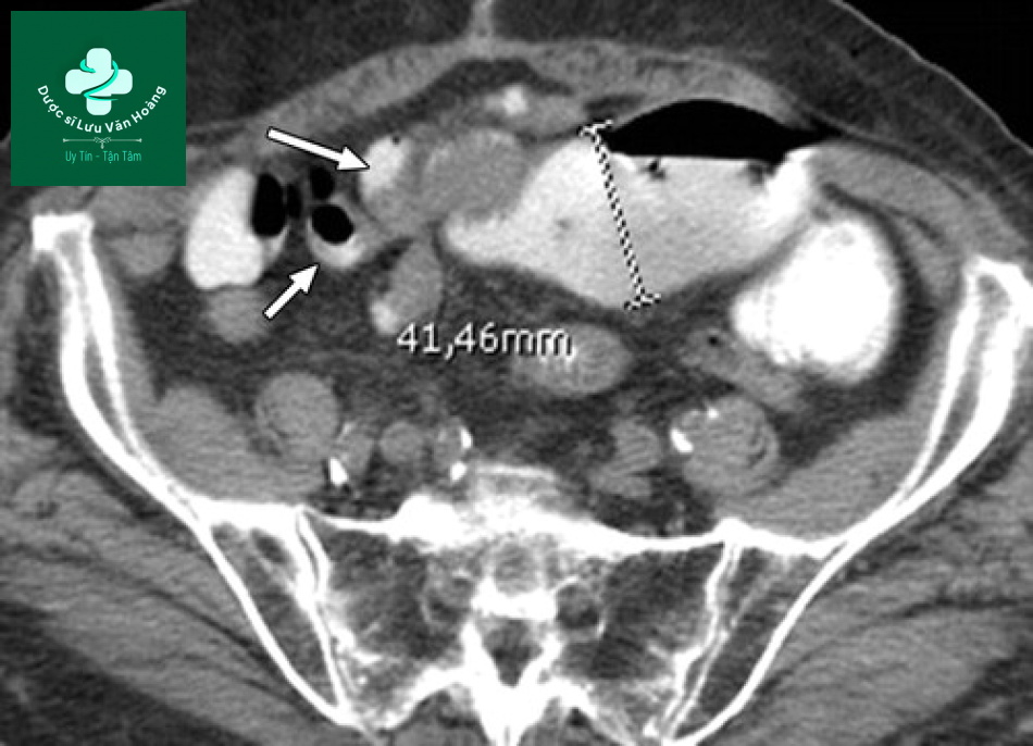 Tắc ruột non - Small Bowel Obstruction: What to Look For 37 Tac ruot non 4