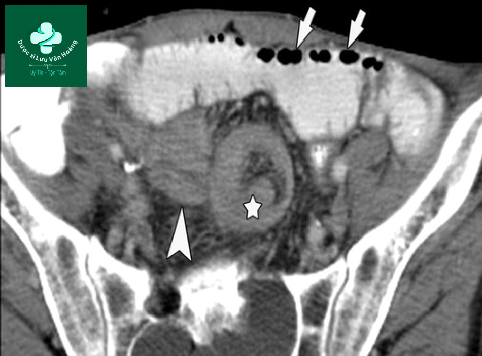 Tắc ruột non - Small Bowel Obstruction: What to Look For 38 Tac ruot non 5