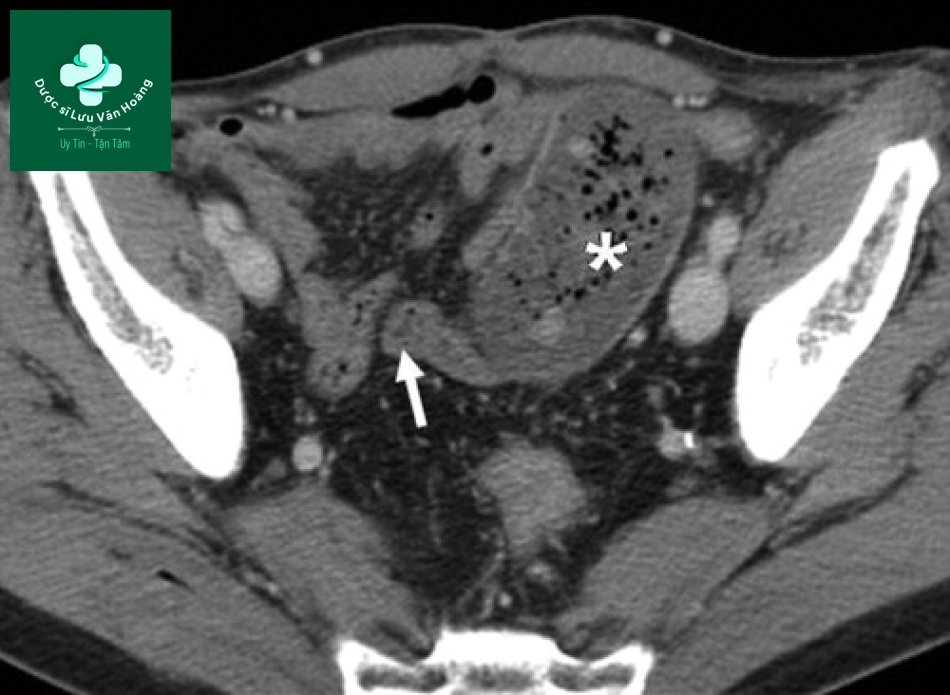 Tắc ruột non - Small Bowel Obstruction: What to Look For 39 Tac ruot non 6