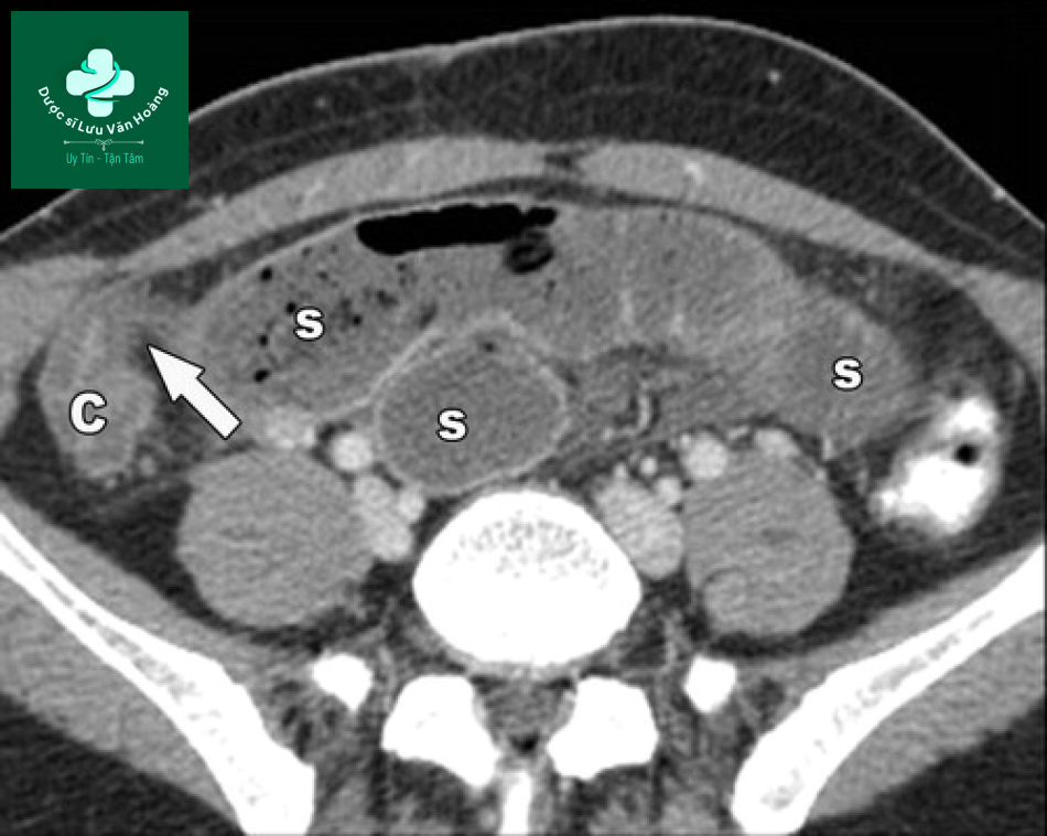 Tắc ruột non - Small Bowel Obstruction: What to Look For 40 Tac ruot non 7