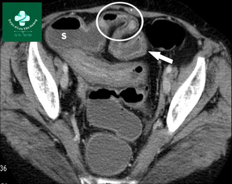 Tắc ruột non - Small Bowel Obstruction: What to Look For 42 Tac ruot non 9