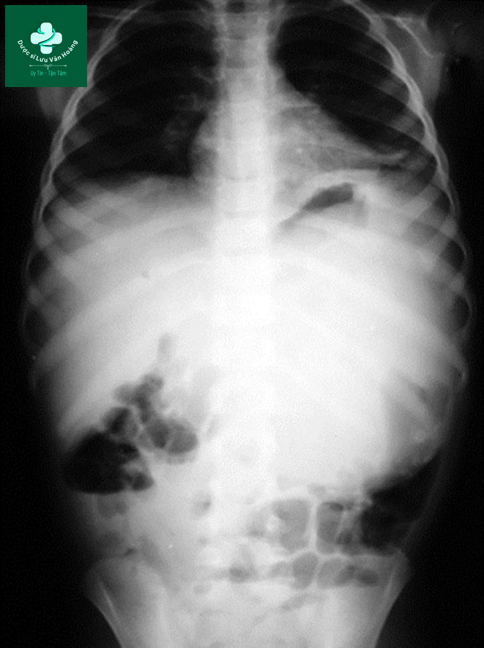 Nang giả tụy - Pancreatic pseudocysts 22 nang gia tuy 10
